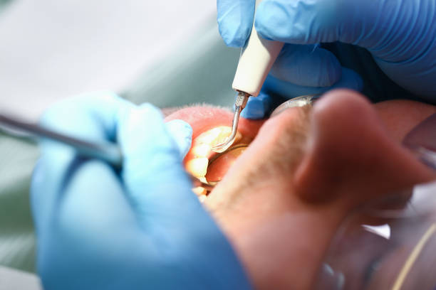 Best Emergency Tooth Extraction in San Pablo, CA