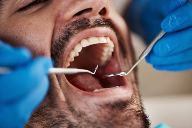 Best Urgent Care for Lost Fillings or Crowns in San Pablo, CA